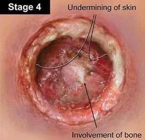 bed sore lawsuit stage 4